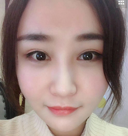 去眼袋手术