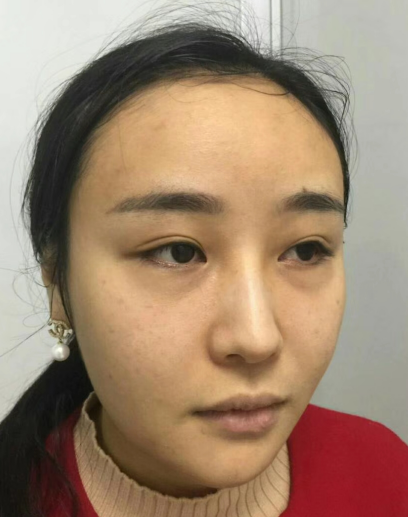 去眼袋手术