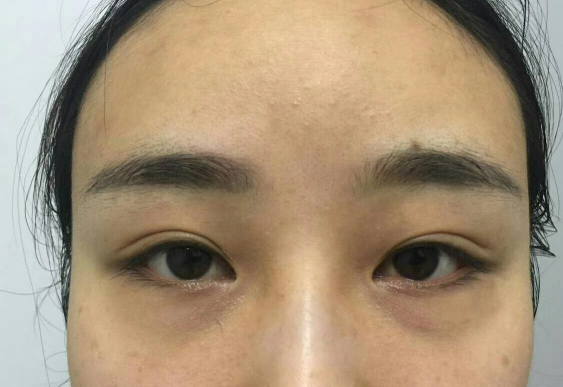 去眼袋手术
