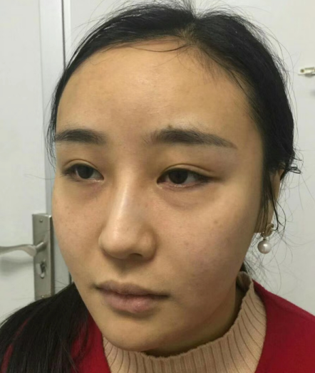 去眼袋手术