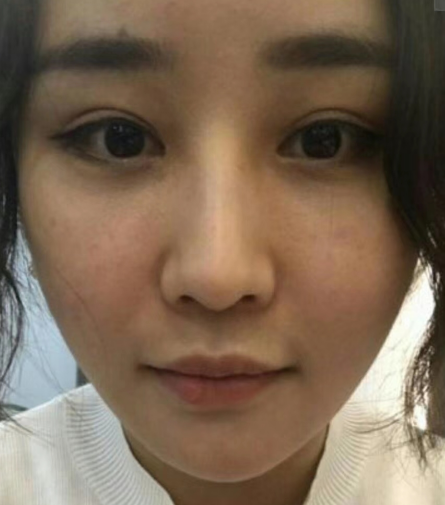 去眼袋手术
