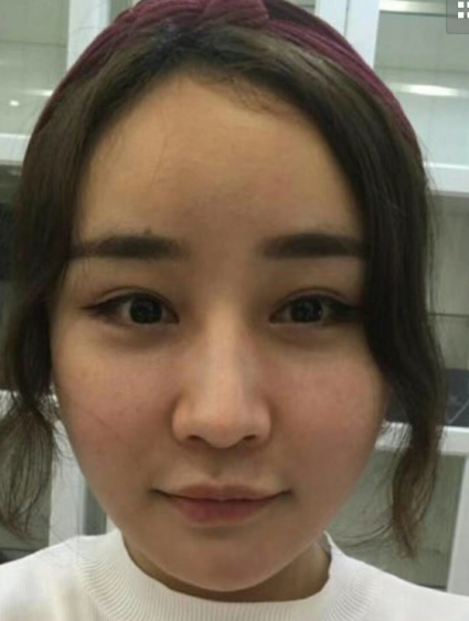 去眼袋手术