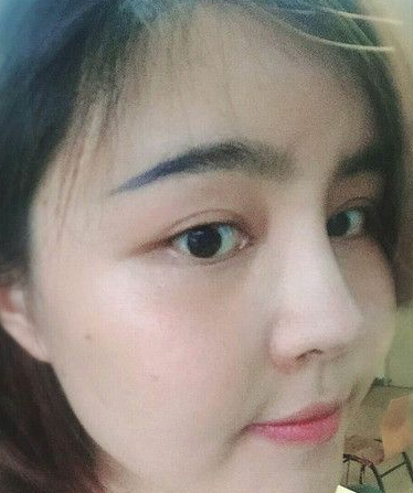 自体脂肪胶填充