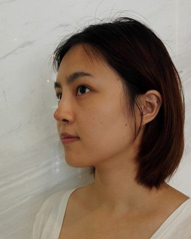 自体脂肪胶填充