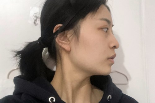 自体脂肪填充