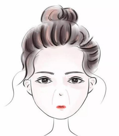 自体脂肪胶填充