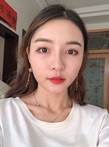 自体脂肪胶填充