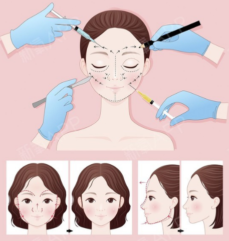 自体脂肪胶填充