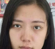 自体脂肪胶填充