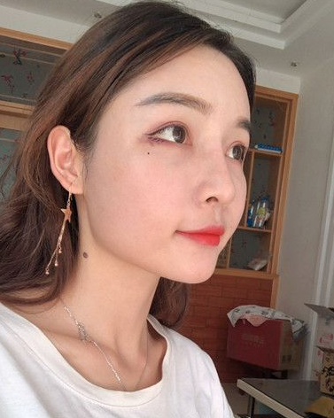 自体脂肪胶填充