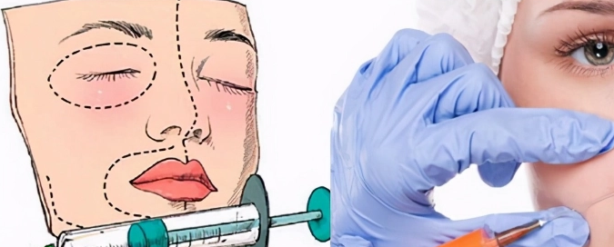 自体脂肪胶填充