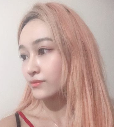 自体脂肪胶填充