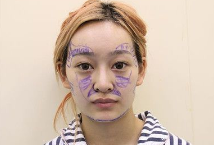自体脂肪胶填充