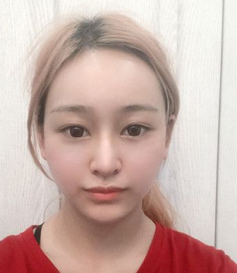 自体脂肪胶填充