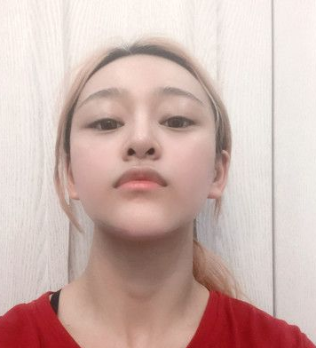 自体脂肪胶填充