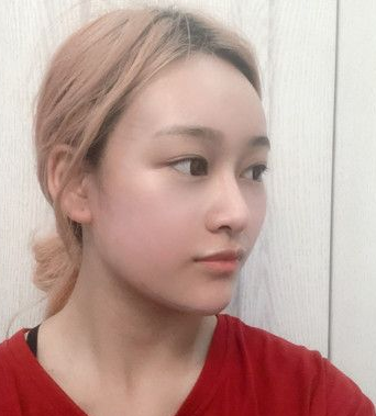 自体脂肪胶填充