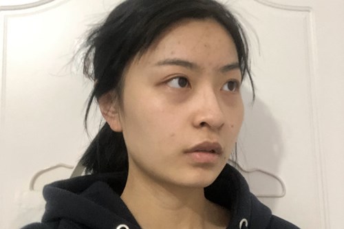 自体脂肪胶填充