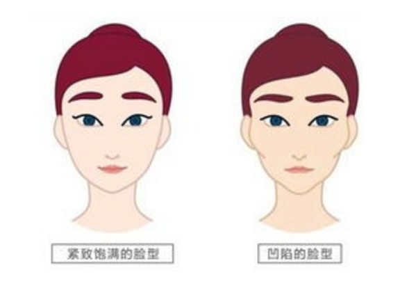 自体脂肪胶填充