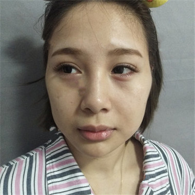 自体脂肪胶填充