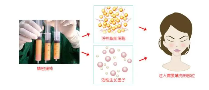 自体脂肪胶填充