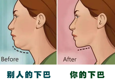 不选玻尿酸用自体脂肪胶填充下巴,效果好吗?111 不选玻尿酸用自体脂肪胶填充下巴,效果好吗?111