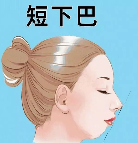 不选玻尿酸用自体脂肪胶填充下巴,效果好吗?111 不选玻尿酸用自体脂肪胶填充下巴,效果好吗?111