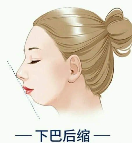 不选玻尿酸用自体脂肪胶填充下巴,效果好吗?111 不选玻尿酸用自体脂肪胶填充下巴,效果好吗?111
