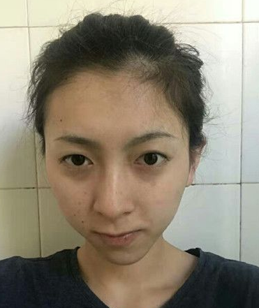 不选玻尿酸用自体脂肪胶填充下巴,效果好吗?111 不选玻尿酸用自体脂肪胶填充下巴,效果好吗?111