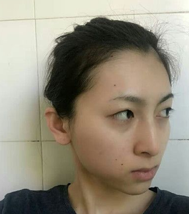 不选玻尿酸用自体脂肪胶填充下巴,效果好吗?111 不选玻尿酸用自体脂肪胶填充下巴,效果好吗?111