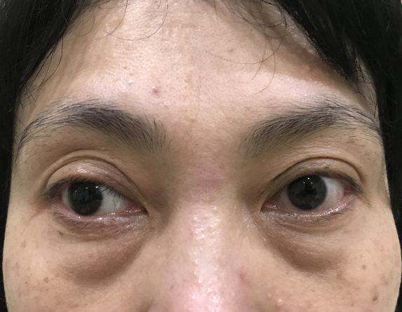 40多岁眼袋很重,还有黑眼圈该如何解决?418 40多岁眼袋很重,还有黑眼圈该如何解决?418
