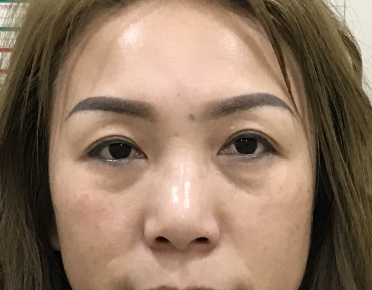 去眼袋手术