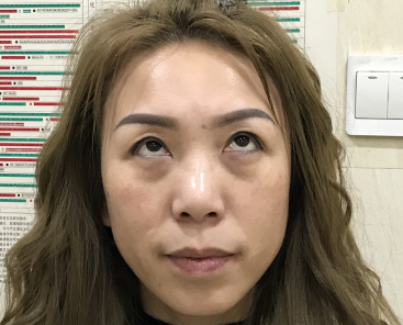 去眼袋手术