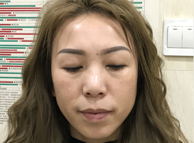 去眼袋手术
