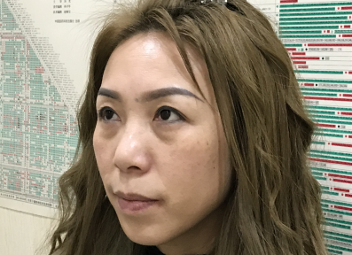 去眼袋手术