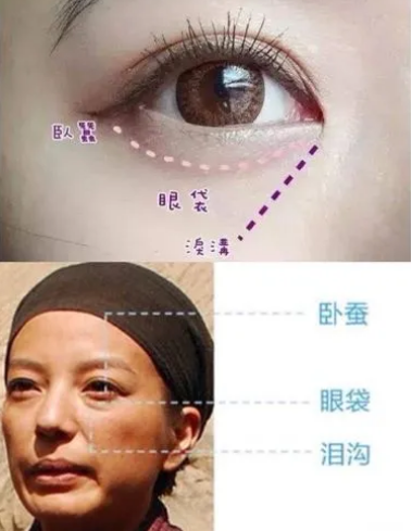 去眼袋手术