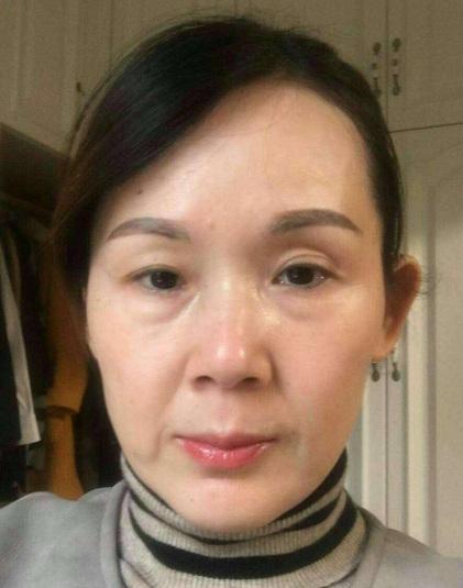 去眼袋手术