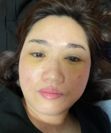 不开刀按摩去眼袋你有什么疑问?我来说下!753 不开刀按摩去眼袋你有什么疑问?我来说下!753