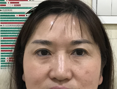 不开刀按摩去眼袋你有什么疑问?我来说下!753 不开刀按摩去眼袋你有什么疑问?我来说下!753