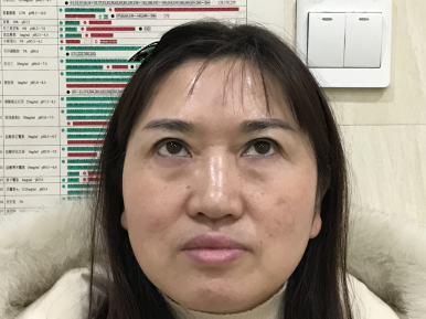 不开刀按摩去眼袋你有什么疑问?我来说下!753 不开刀按摩去眼袋你有什么疑问?我来说下!753