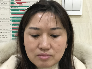 不开刀按摩去眼袋你有什么疑问?我来说下!753 不开刀按摩去眼袋你有什么疑问?我来说下!753
