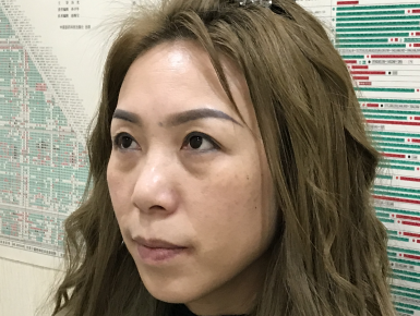 去眼袋手术