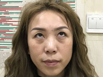 去眼袋手术
