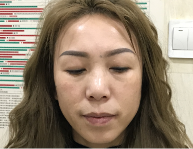去眼袋手术