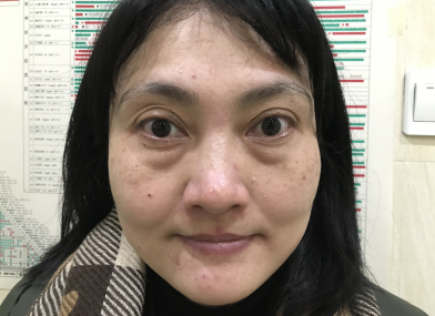 去眼袋手术