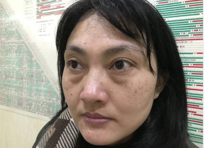 去眼袋手术