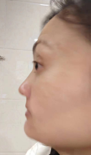 去眼袋手术