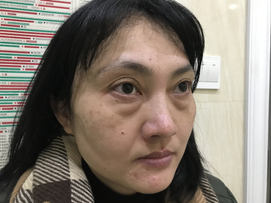 去眼袋手术
