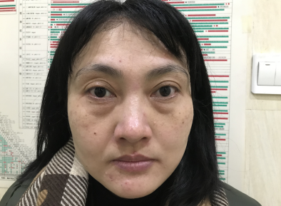 去眼袋手术