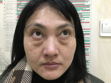去眼袋手术