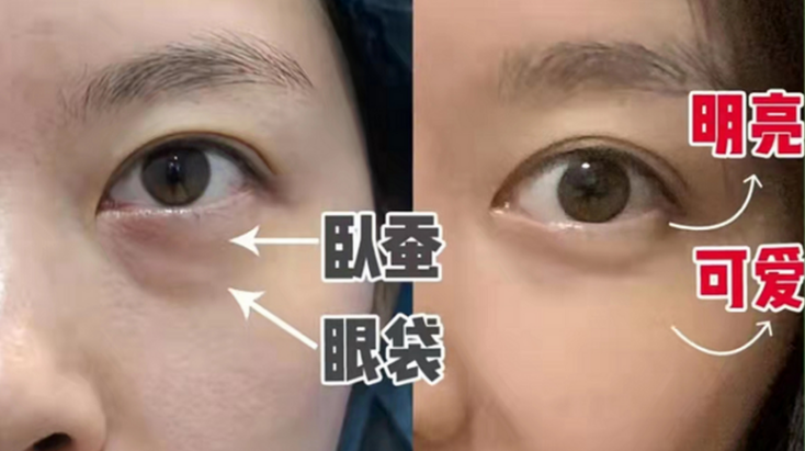去眼袋手术